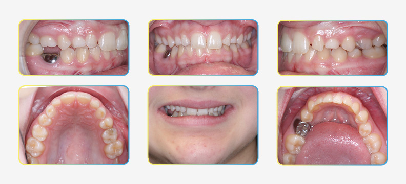Intial Orthodontic treatment photos