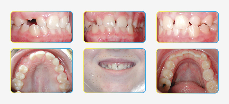 Final Photos after phase I orthodontic treatment