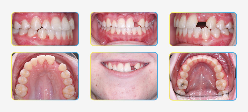 Final orthodontic results