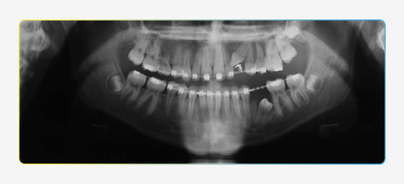 Panoramic X-ray showing progress of impacted teeth