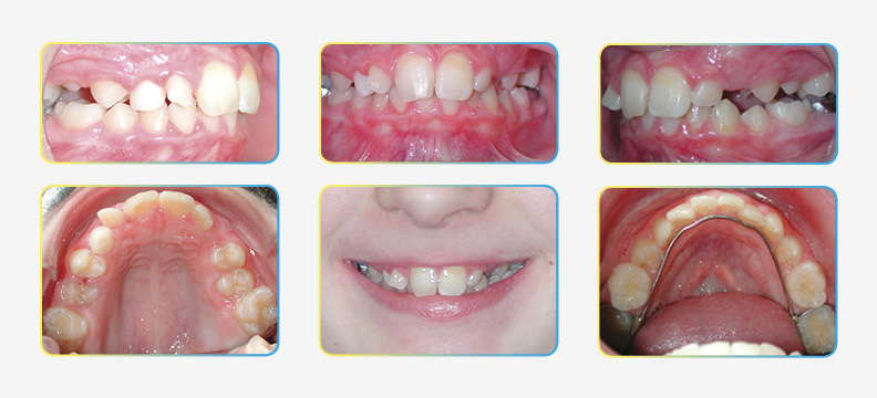 Initial Orthodontic Photos
