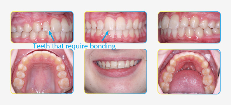 Final Orthodontic Results