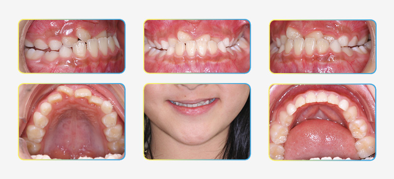 Initial orthodontic photos before face mask