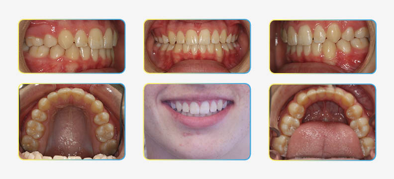 Final orthodontic photos
