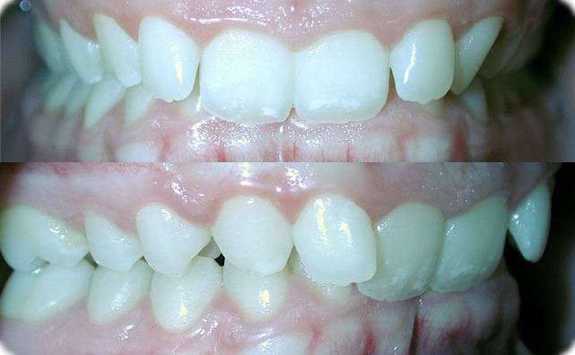 Class II Div II orthodontic deep bite