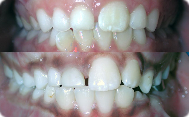 impacted central incisors