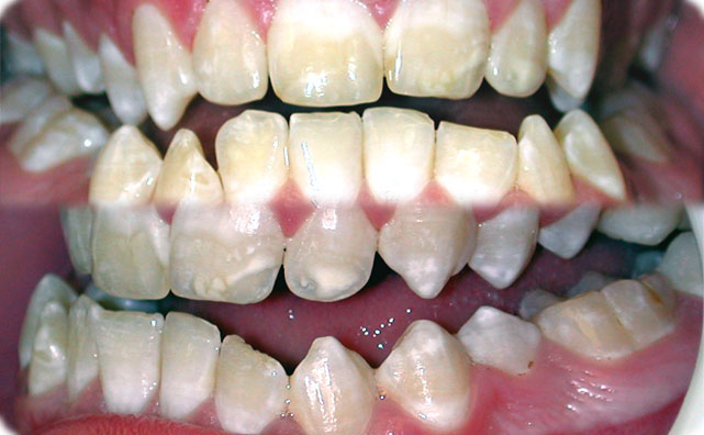 skeletal open bite orthodontic problem
